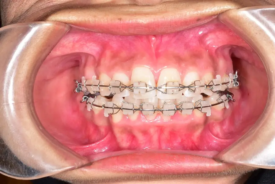 Damon Braces In Vasant Kunj
