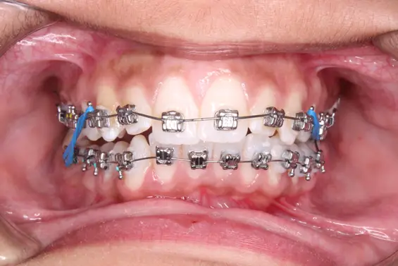 Braces Treatment By Experienced Orthodontist