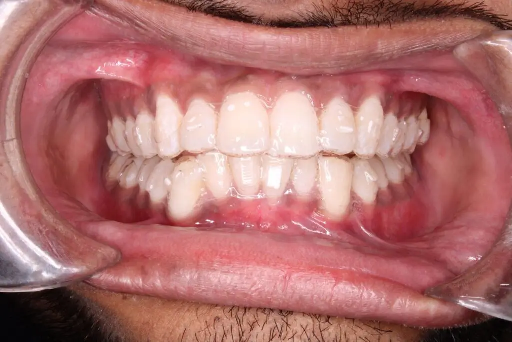 Invisalign Consultation At Dr Lillys Dentistry