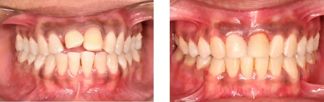 Treatment Of Mobile Teeth