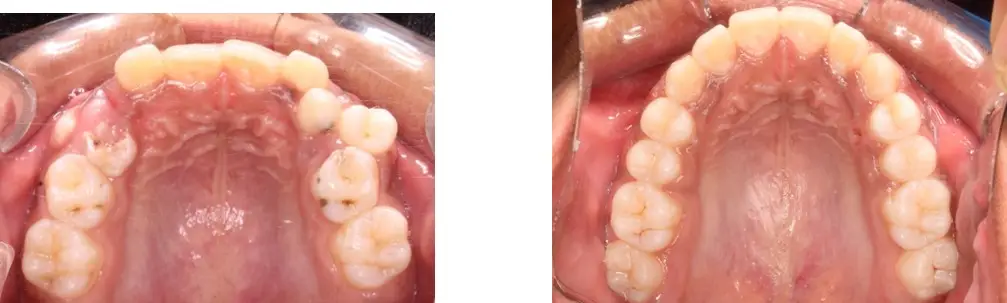 Affordable Zirconia Crown