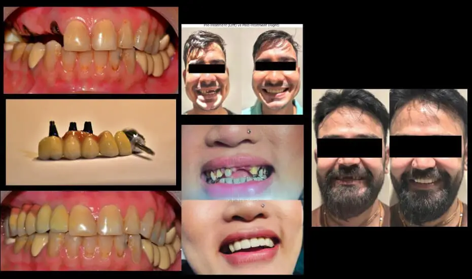 Best Tooth Implant Nearby